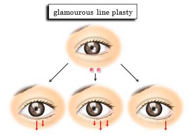 glamourous line plasty