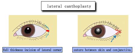 lateral canthoplasty