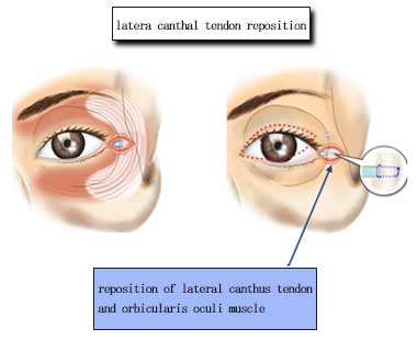 latera canthal tendon reposition