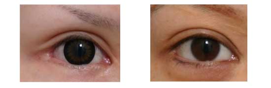 Adverse effect of lateral canthoplasty