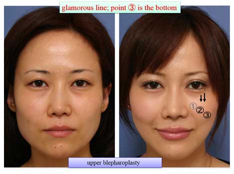 glamorous line; point ③ is the bottom upper blepharoplasty