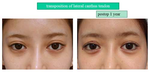 transposition of lateral canthus tendon postop 1 year