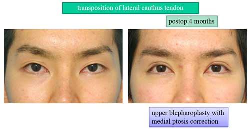 transposition of lateral canthus tendon postop 4 year