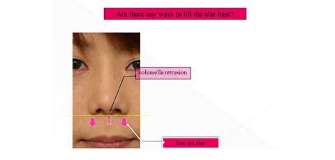 鼻孔縁の位置関係説明スライド