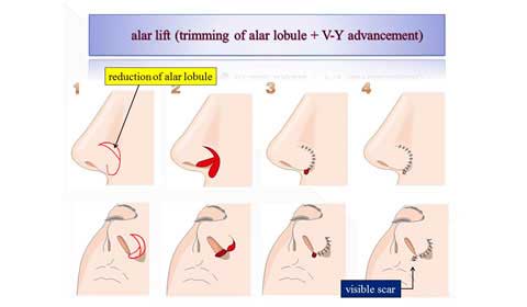 鼻孔縁挙上術の説明スライド