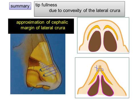 第101回 鼻尖縮小術：軟骨の処理をイラストでの紹介