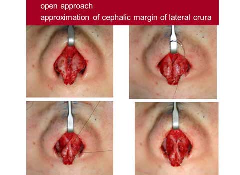 第101回 鼻尖縮小術：軟骨の処理 術中の写真