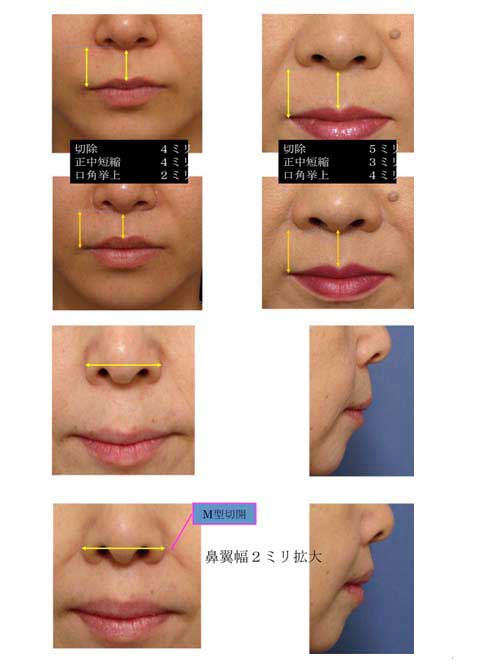 上口唇リフト（鼻下長修正術）の効果B