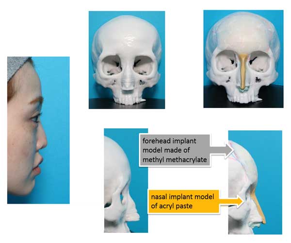 forehead implant model made of methyl methacrylate and nasal implant model of acryl paste
 