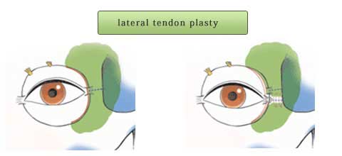 外眼角靭帯移動術の説明スライド
