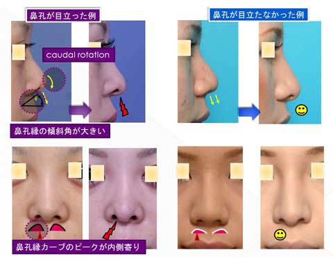 鼻孔が目立った症例と目立たなかった症例