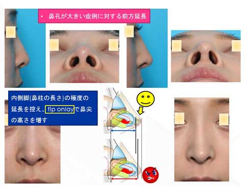 鼻孔が大きい症例に対する前方延長スライド説明