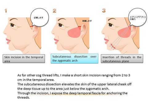 フェイスリフト手順１～3