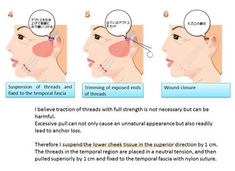 フェイスリフト手順4～6