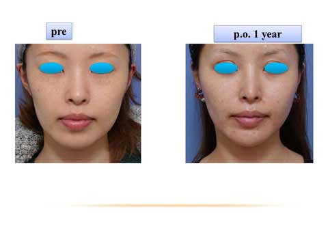 症例写真１術前術後スライド