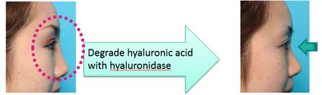 Degrade hyaluronic acid  with hyaluronidase