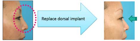 Replace dorsal implant