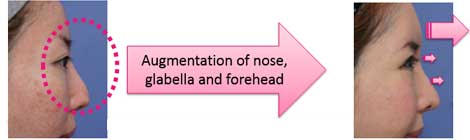 Augmentation of nose, glabella and forehead