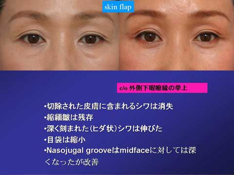 skin flap法の症例結果 3