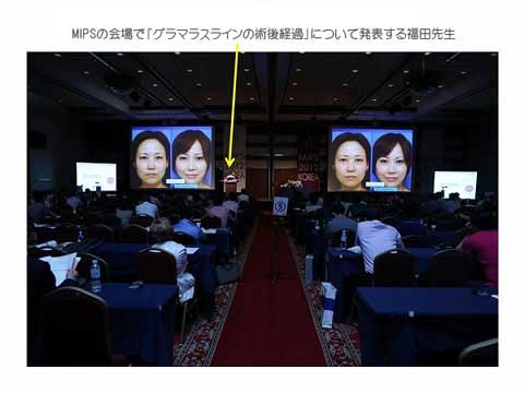 低浸襲 形成美容外科学会 MIPS発表風景