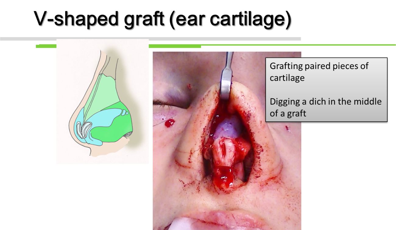 V-shaped graft(ear cartilage)
