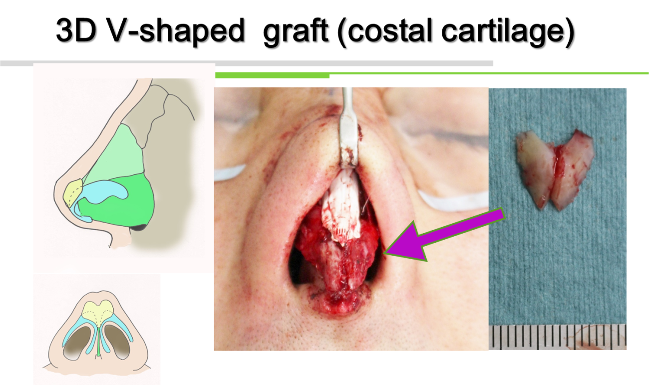 3D V-shaped graft(costal cartilage)