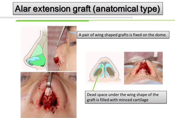 Alar extension graft(anatomical type)