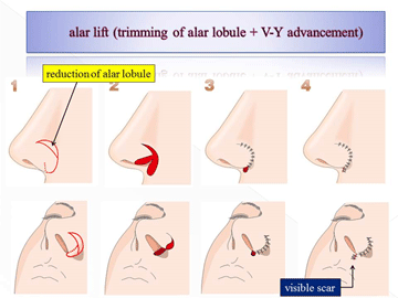 alar lift(trimming lobule+V-Y advancement)