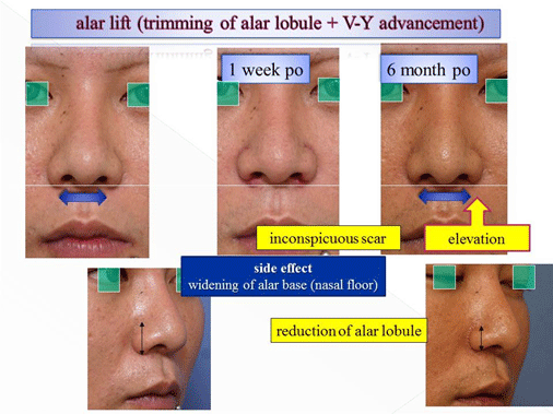 alar lift(trimming of alar lobule+V-Y advancement)1