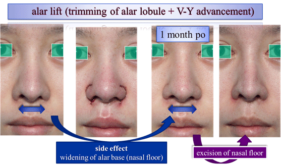 alar lift(trimming of alar lobule+V-Y advancement)2