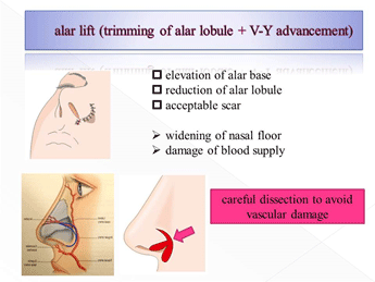 alar lift(trimming of alar lobule+V-Y advancement)3