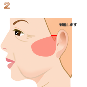 Subcutaneous  dissection over the zygomatic arch