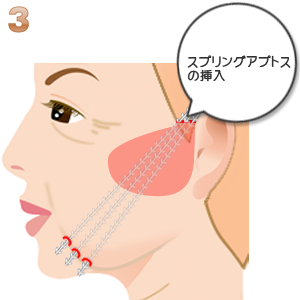 Insertion of threads in the subcutaneous plane