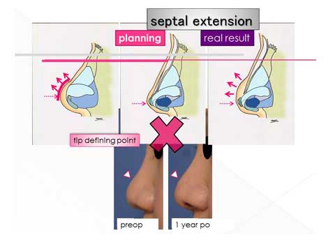 鼻尖形成術の問題点についての説明スライド