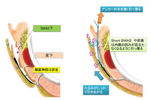 pingtian式faceliftの方法