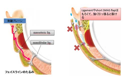 以前報告した ligament の問題点