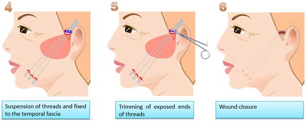 Spring Thread for face lift flow-2