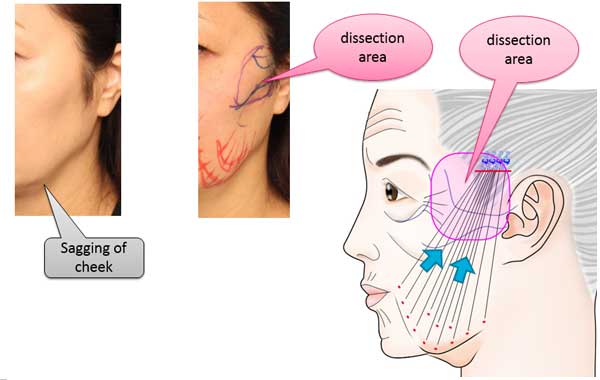 Spring Thread for face lift commentary-1