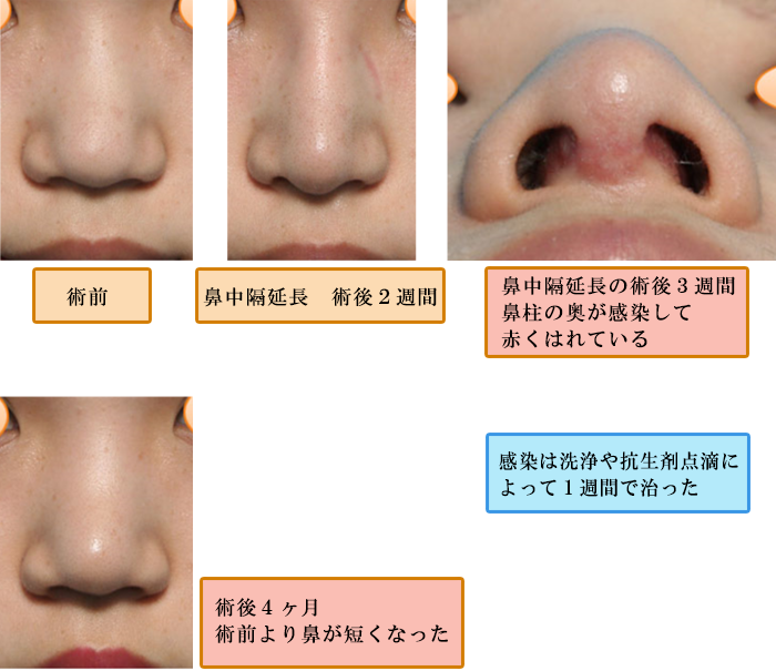 鼻中隔 延長 元 に 戻す