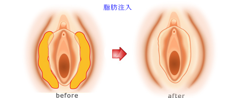 大陰唇脂肪