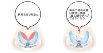 鼻尖形成