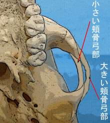 頬骨削り