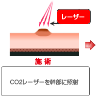 CO2レーザー