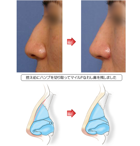 わし鼻