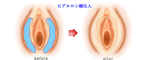 大陰唇ヒアルロン酸