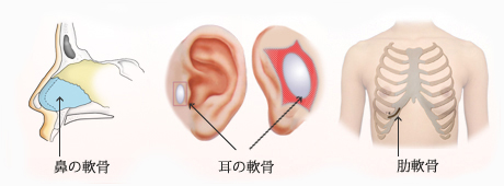 鼻中隔延長術に使用する軟骨