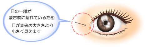 目頭切開でどこまで目が大きくなるのか