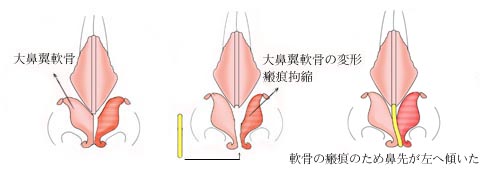 鼻尖や鼻柱の傾き・鼻孔の左右差