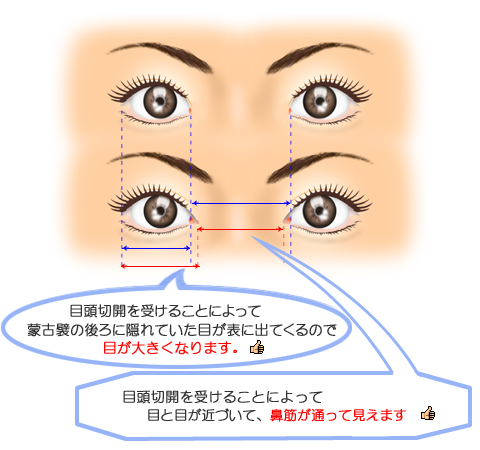 目頭切開でどこまで目が大きくなるのか