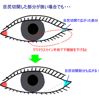 目尻切開とグラマラスライン